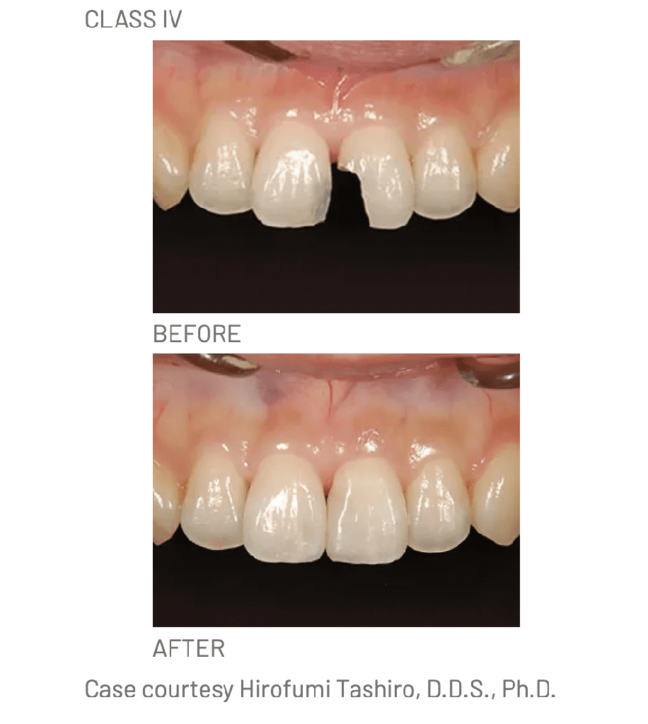 Resina Composite Palfique LX5 Mini Tokuyama (1)