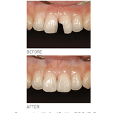 Resina Composite Palfique LX5 Mini Tokuyama (1)