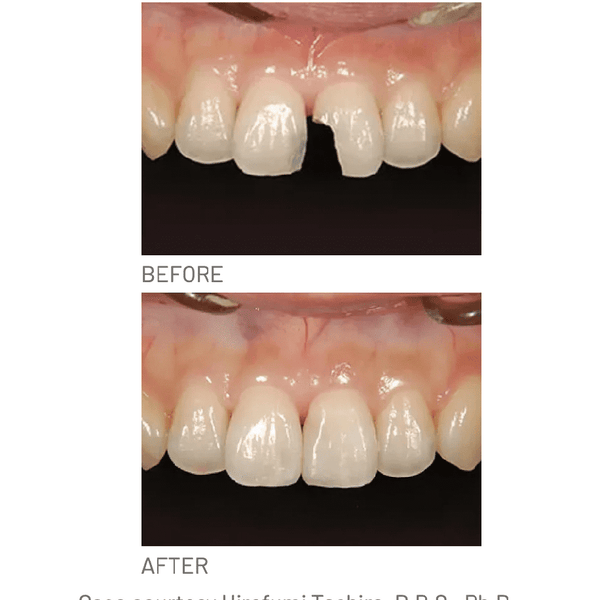 Resina Composite Palfique LX5 Mini Tokuyama (1)