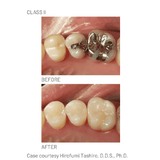 Resina Composite Palfique LX5 Mini Tokuyama