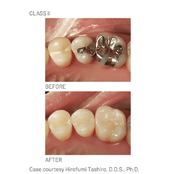 Resina Composite Palfique LX5 Mini Tokuyama
