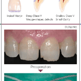 Resina Composite fluida Palfique Universal Flow M Tokuyama (2)